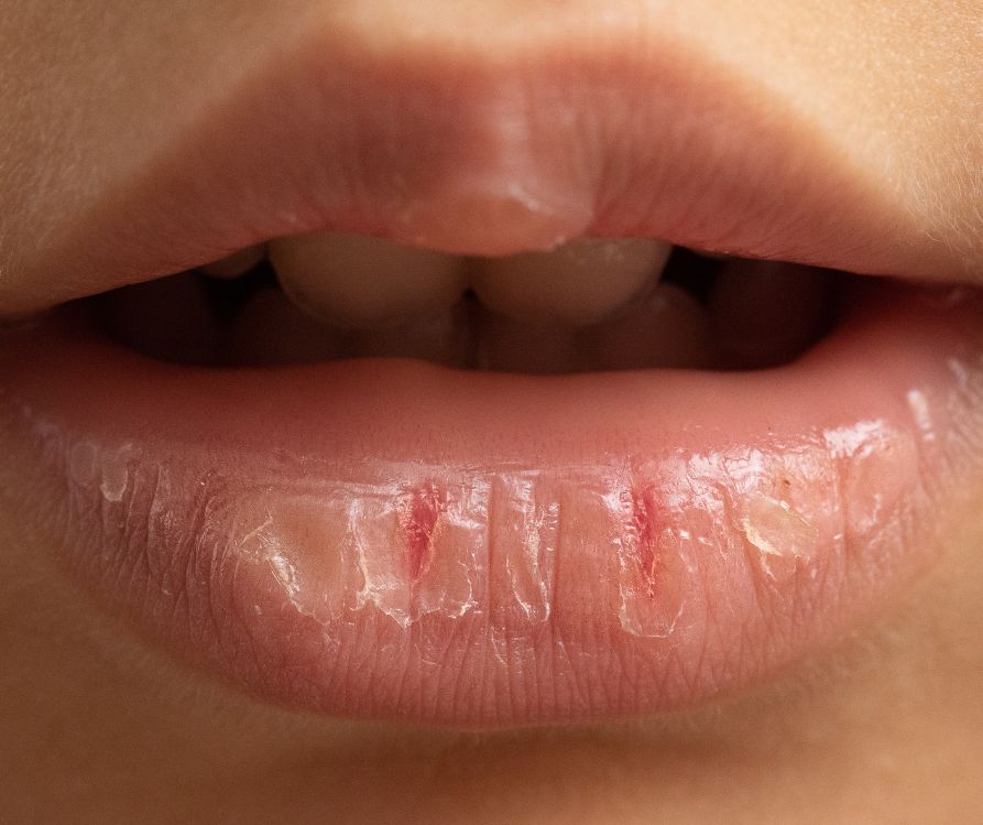 A person with chapped lips due to cold and dehydration